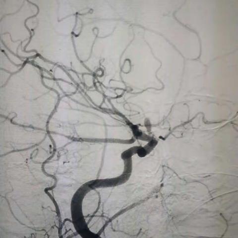 两次破裂出血的右颈内动脉眼动脉段血泡样动脉瘤栓塞治疗一例----浙一医院  潘剑威   范卫健