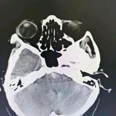 基底动脉极重度狭窄的破裂大脑后动脉动脉瘤栓塞术