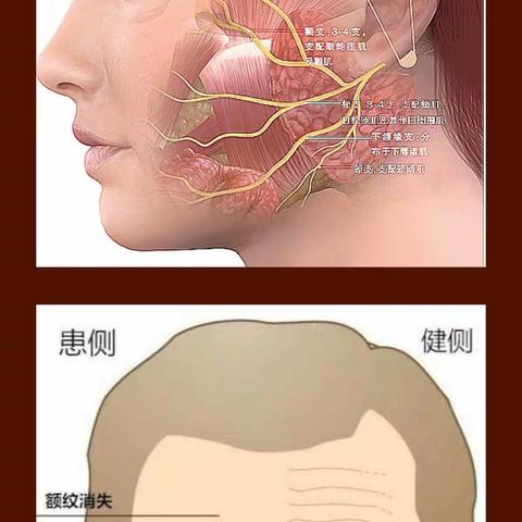 不忘初心向前走，仁心仁术佑健康针灸科面瘫病护理业务查房