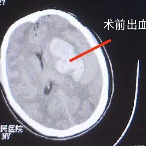 【周医•神经外科】患者的健康——我们的守护