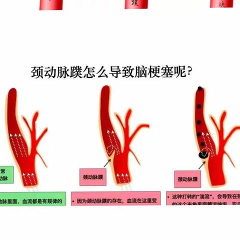 “蹼朔迷离”的颈动脉狭窄