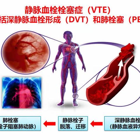 10.13 世界血栓日~不要让血栓堵住您的生命