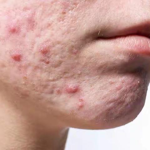皮肤科高医生青春痘科普分享