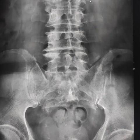 脊索瘤（骶尾骨）