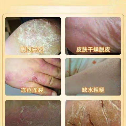 冬天来了，皮肤外治来帮您