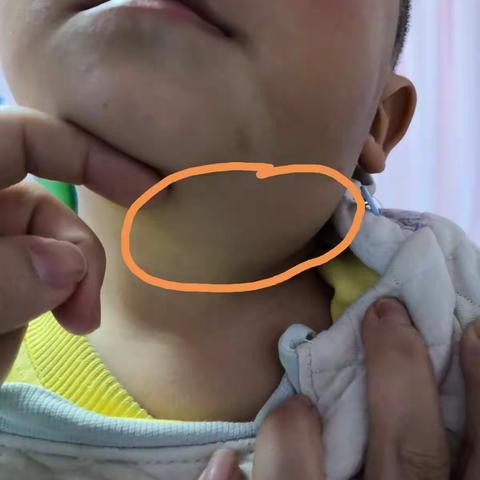 手术个案分析/颈部囊性淋巴管瘤手术治疗体会