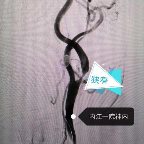疫情时期克服重重困难，左侧颈内动脉重度狭窄支架植入术