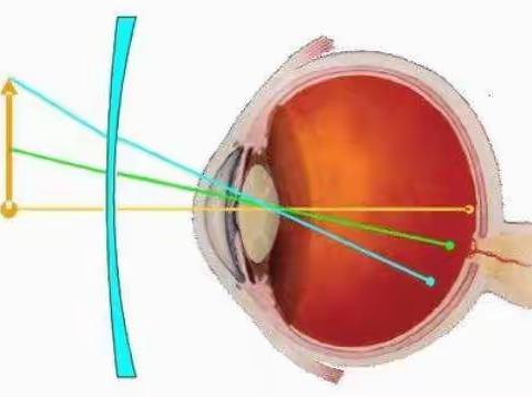 近视控制新手段——周边视力控制