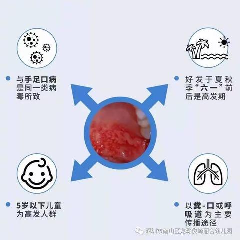 疱疹性咽峡炎预防小知识