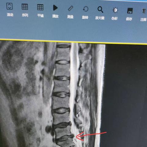 腰椎间盘突出症康复辩证治疗    病例分析