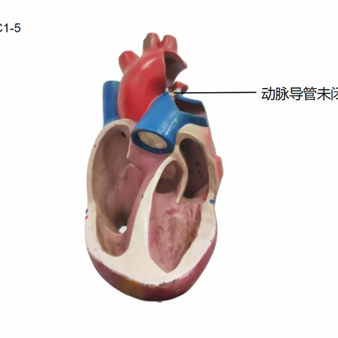 心血管先天畸形C1-5