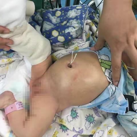 南华附二新生儿多学科合作团队为直肠闭锁宝宝再建生命线