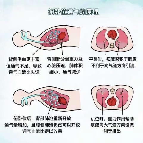 助力呼吸自由  俯卧位通气——重症医学科