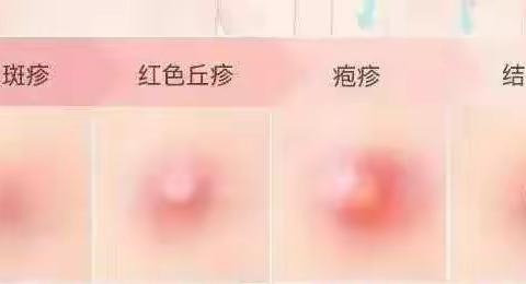 水痘来袭如何预防！合肥小森林双凤幼儿园温馨提示: