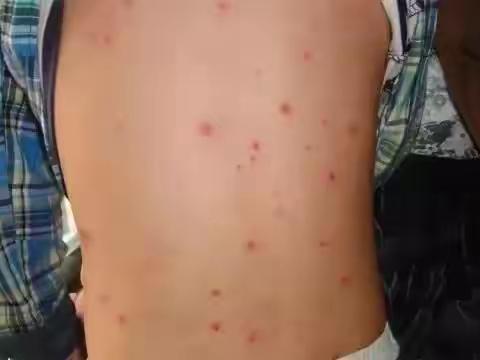 温馨提示！进入水痘高发期，请家长做好预防工作！