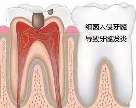 不同类型牙痛的用药技巧