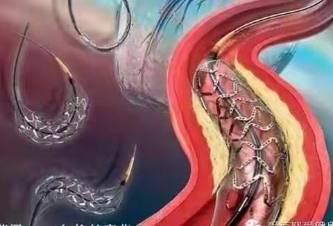 心脏支架：支不起生命，架不了健康，后患无穷！