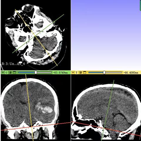 3D-Slicer下脑出血定位穿刺