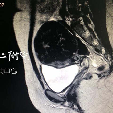 陕中二附院海扶治疗巨大子宫肌瘤一例