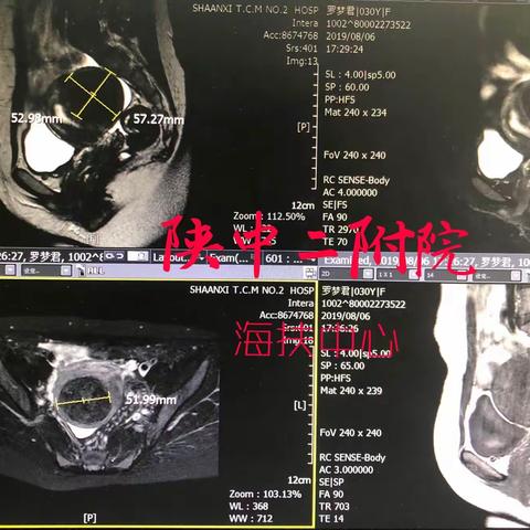 海扶刀——一种不开刀、不流血无创让患者治疗受伤害最小的方法