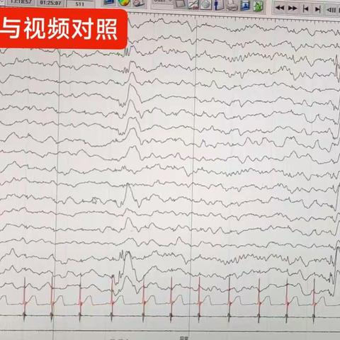 视频脑电图检查之发作间期异常放电