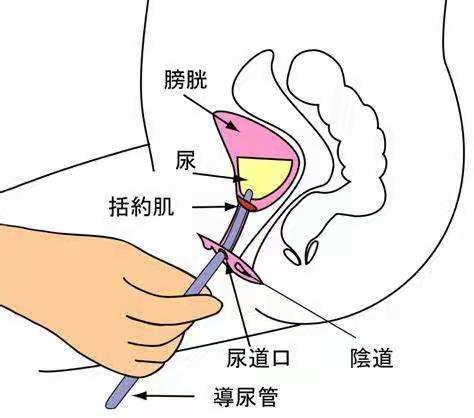 脊髓损伤间歇导尿健康教育