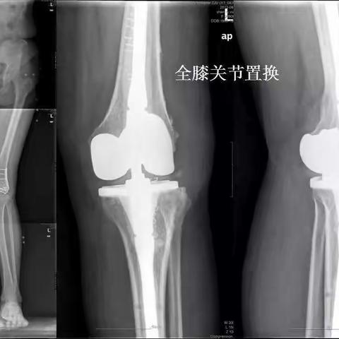 膝关节置换健康教育