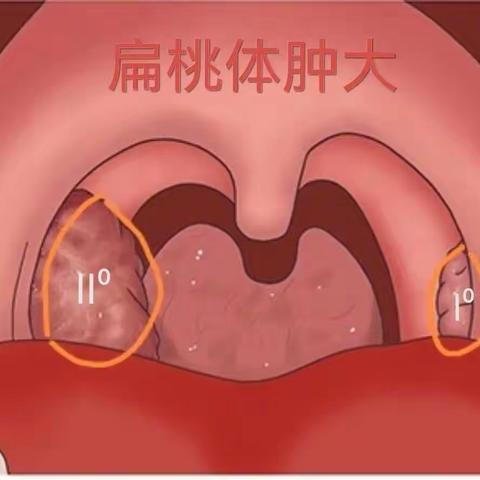 扁桃体啄烙技术