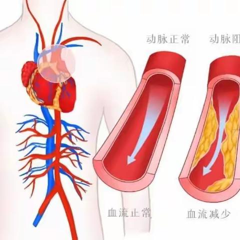 你知道什么是“血管斑块”吗？有了斑块该怎么办？