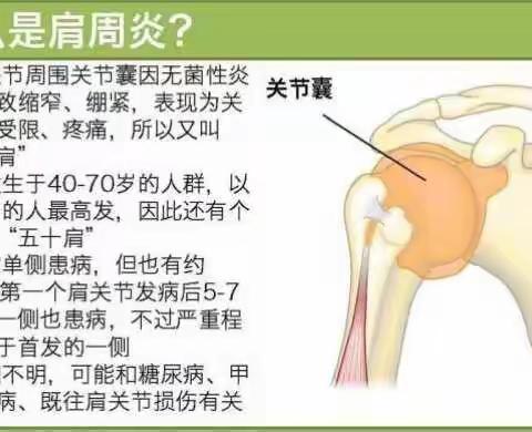 肩周炎（冻结肩）的康复治疗