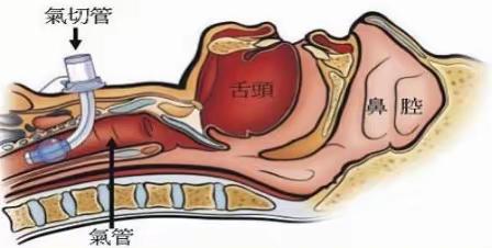气管切开患者吞咽障碍的康复护理