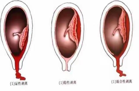 化险为夷的胎盘早剥