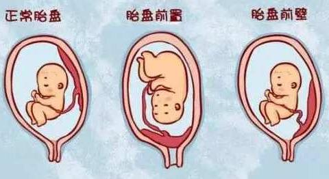 市二院一体化产房成功挽救一完全性前置胎盘并胎盘植入产妇，并保留子宫