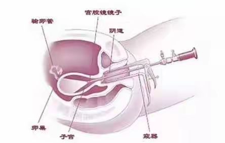 子宫腔里长息肉，该怎么办呢？