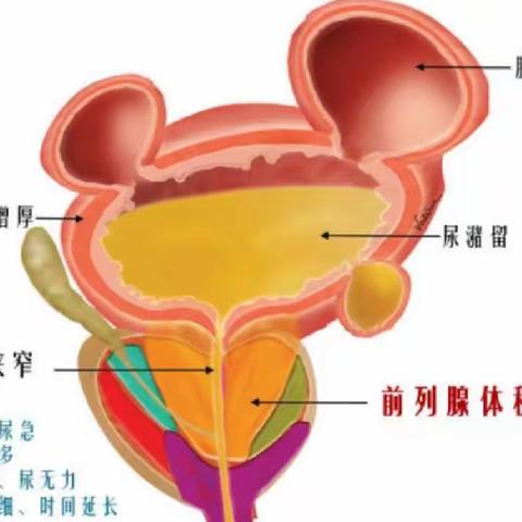 前列腺增生治疗因人而异！！！