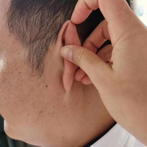 中医适宜技术——耳尖放血的功效及注意事项