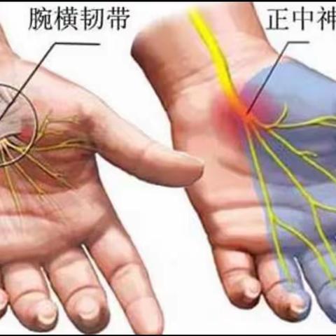 超声引导下腕管综合征的精准治疗