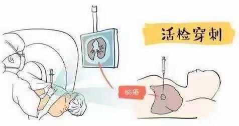 一针探结节，肺穿揪真凶——邓州市人民医院完成1例高难度肺穿