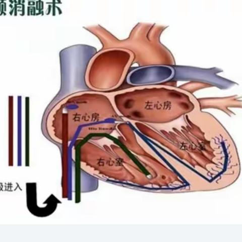 首例射频消融术！易门县人民医院再谱新篇章