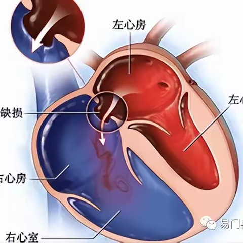 心脏有个“洞”巧用“小伞”堵 ，我院心内科成功开展了首例先心病房间隔缺损介入封堵术