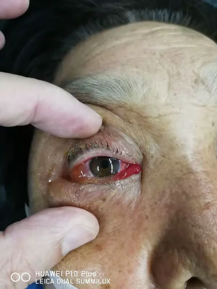 动脉瘤破了,也可表现突眼,球结膜水肿