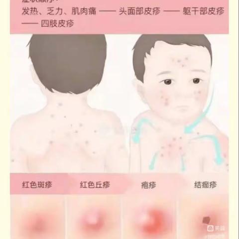 预防春季校园常见传染病