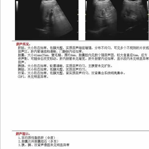 肝胆外科病例分享-胆囊切除术之特殊病理胆囊