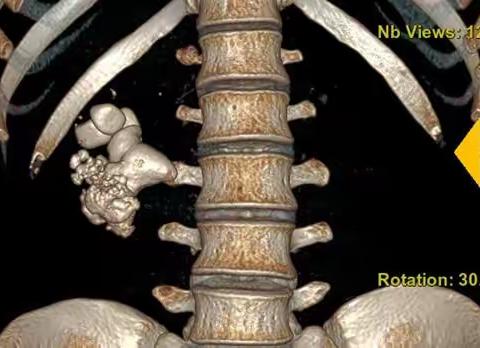 泌尿外科：经皮肾镜碎石清石术治疗巨大肾结石