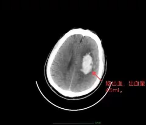 我院成功实施一例微创颅内血肿清除术