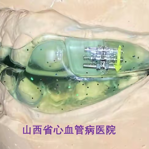 阻鼾器在治疗阻塞性睡眠呼吸暂停综合征的应用