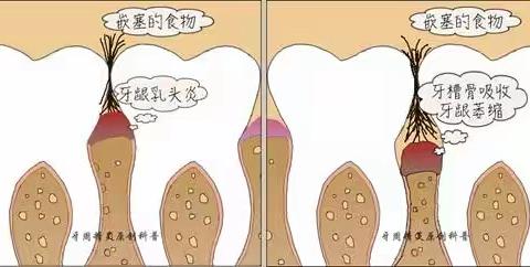 牙体缺损修复后食物嵌塞的预防和治疗（一）