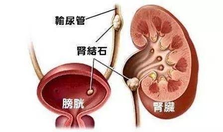 ​20种导致肌酐升高的情况，避开这些，远离肾衰竭