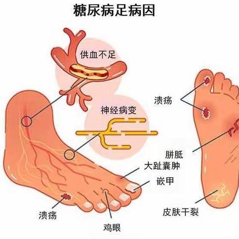 鲁中烧伤与创面修复中心提醒：及早认识糖足的初期症状及治疗……