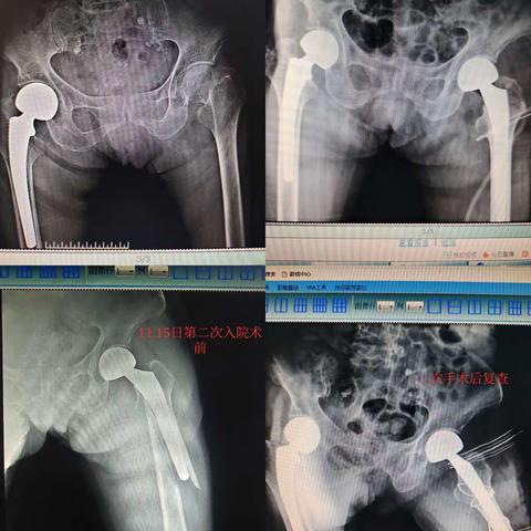 “髋”慰人心，骨处逢生 脊柱关节科成功开展髋关节置换翻修术